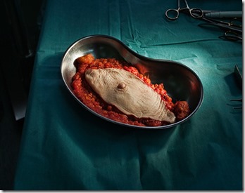 Breast cancer (whole breast removed) #1, pigment print, 60 cm x 40 cm.  From the series Removals 2011-2013 by Maija Tammi.